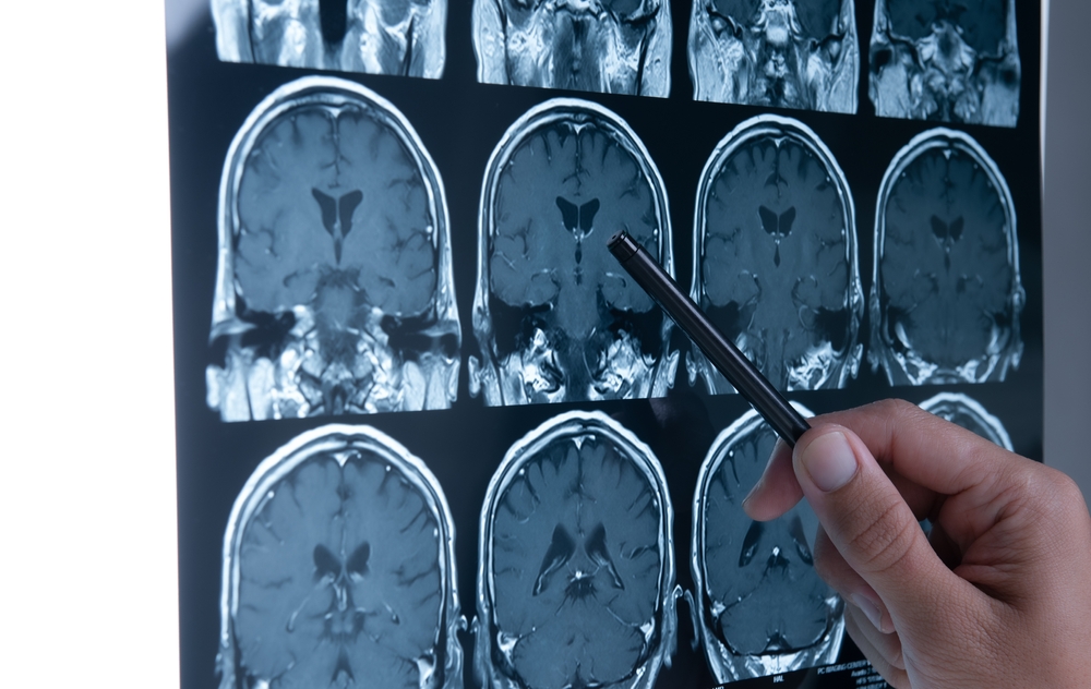 How Long Does a Brain Injury Claim Take