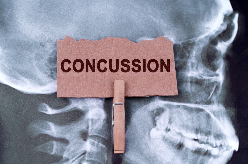 Against the background of an X-ray of the skull, a plate with the inscription - concussion